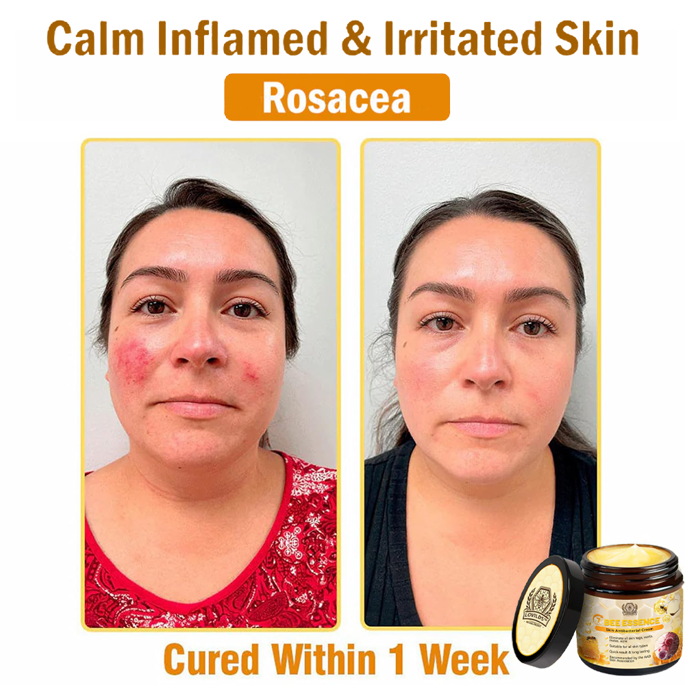 LOVILDS™ Bee Essence Skin Antibacterial Cream—used to treat a variety of skin diseases (AAD recommended)