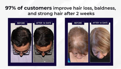 🌿 LOVILDS™ Natural Hair Regrowth Spray – 70% OFF Ends Tonight!