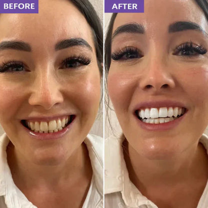 Purple Teeth Whitening Strips