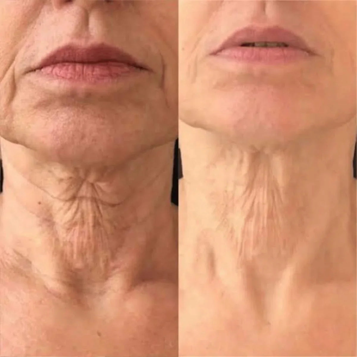 🌼Roller Massage Neck Cream 🧴 Collagen & Hyaluronic Acid | Firms Neck, Reduces Wrinkles & Double Chin